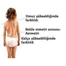 Skolyozun belirtileri